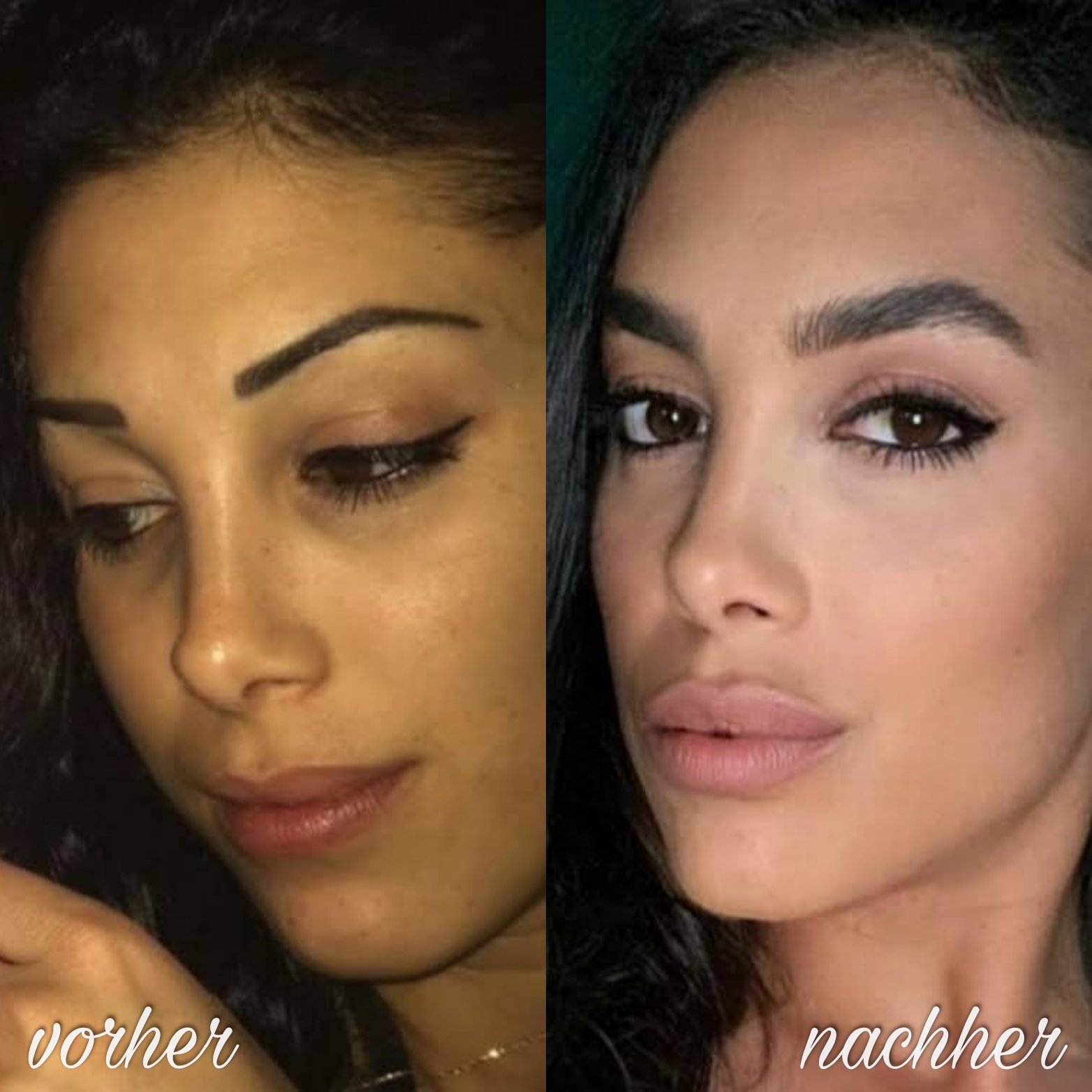 BrowLifting Ergebnis 5